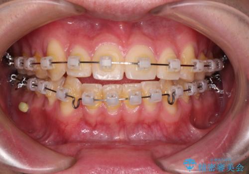 八重歯と前歯のクロスバイト　ワイヤー装置で短期間矯正の治療中
