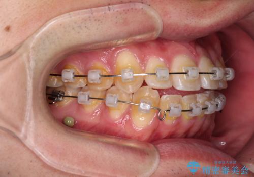 八重歯と前歯のクロスバイト ワイヤー装置で短期間矯正の治療中