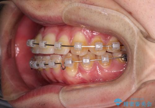八重歯と前歯のクロスバイト ワイヤー装置で短期間矯正の治療中