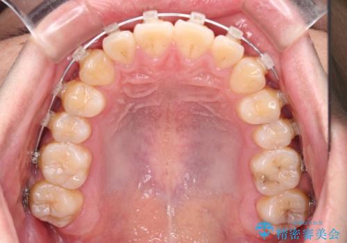 八重歯と前歯のクロスバイト ワイヤー装置で短期間矯正の治療中