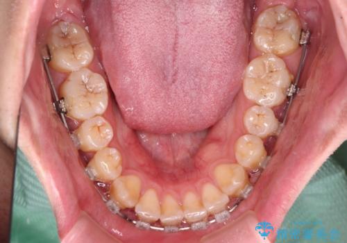 八重歯と前歯のクロスバイト　ワイヤー装置で短期間矯正の治療中