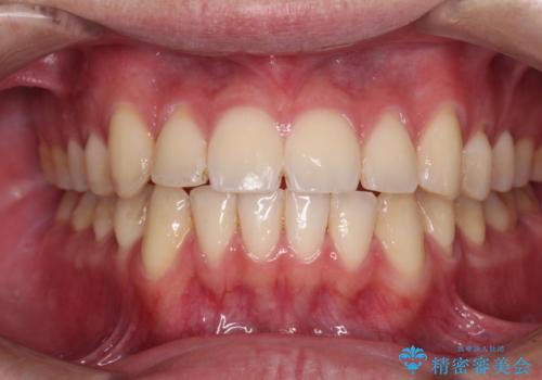 八重歯と前歯のクロスバイト　ワイヤー装置で短期間矯正の症例 治療後