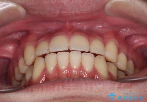 八重歯と前歯のクロスバイト ワイヤー装置で短期間矯正の治療後