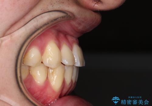 八重歯と前歯のクロスバイト ワイヤー装置で短期間矯正の治療後