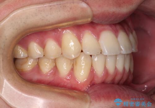 八重歯と前歯のクロスバイト　ワイヤー装置で短期間矯正の治療後