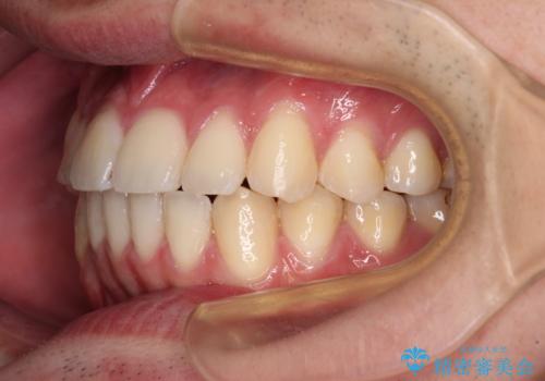 八重歯と前歯のクロスバイト　ワイヤー装置で短期間矯正の治療後