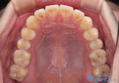 八重歯と前歯のクロスバイト ワイヤー装置で短期間矯正の治療後