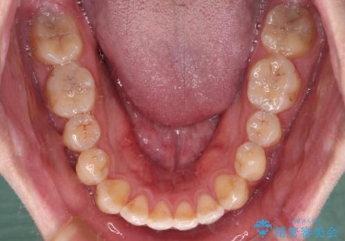 八重歯と前歯のクロスバイト ワイヤー装置で短期間矯正の治療後