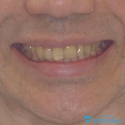 欠損歯列の矯正治療とインプラント治療の治療後（顔貌）