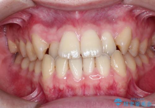 前歯のデコボコ　インビザラインによる目立たない矯正の症例 治療前