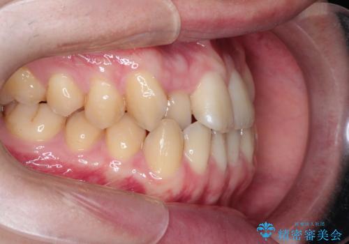 前歯のデコボコ インビザラインによる目立たない矯正の治療前