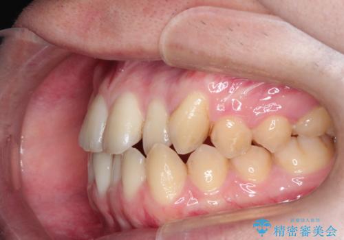 前歯のデコボコ　インビザラインによる目立たない矯正の治療前