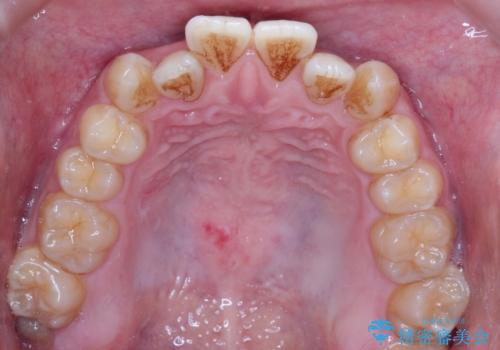 前歯のデコボコ　インビザラインによる目立たない矯正の治療前