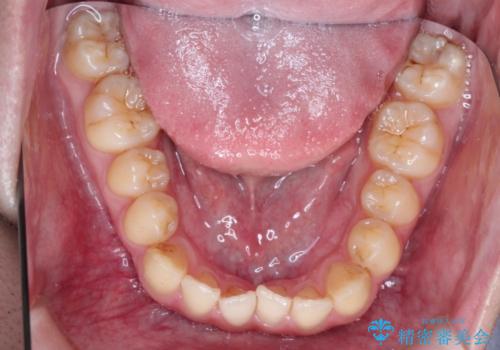 前歯のデコボコ インビザラインによる目立たない矯正の治療前
