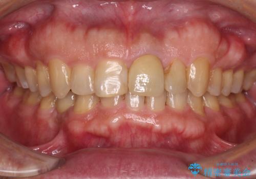 欠損歯列の矯正治療とインプラント治療の症例 治療後