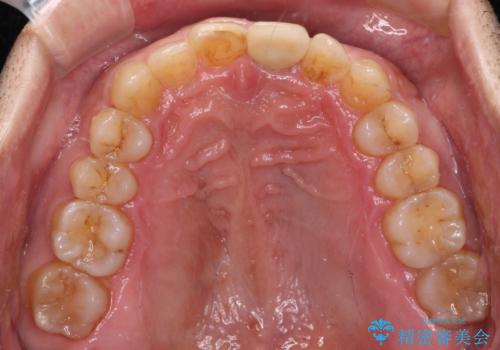 欠損歯列の矯正治療とインプラント治療の治療後