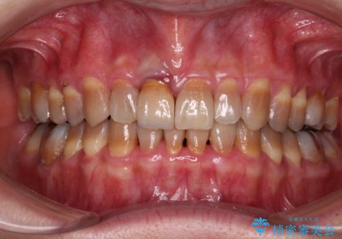 咬み合わせを治したい インビザラインによる矯正治療の症例 治療後