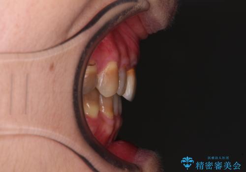 咬み合わせを治したい インビザラインによる矯正治療の治療後