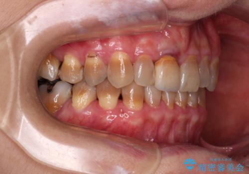 咬み合わせを治したい インビザラインによる矯正治療の治療後