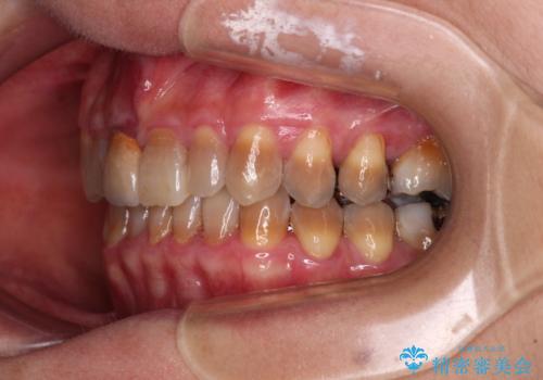 咬み合わせを治したい インビザラインによる矯正治療の治療後