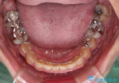 咬み合わせを治したい インビザラインによる矯正治療の治療後