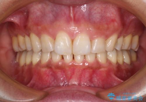 抜歯矯正の後戻りでできたスペース インビザライン矯正とセラミック治療の症例 治療後