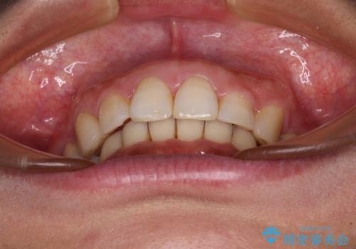抜歯矯正の後戻りでできたスペース インビザライン矯正とセラミック治療の治療後