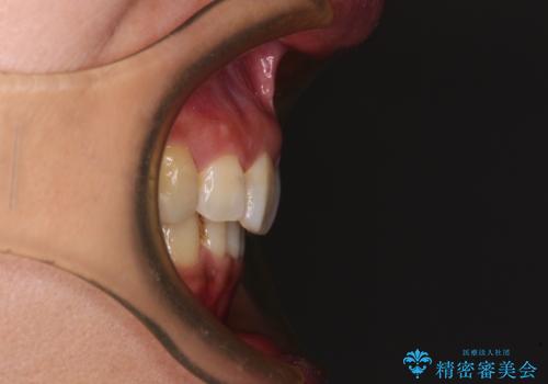 抜歯矯正の後戻りでできたスペース インビザライン矯正とセラミック治療の治療後