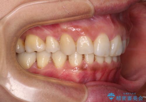 抜歯矯正の後戻りでできたスペース インビザライン矯正とセラミック治療の治療後
