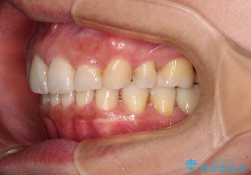 抜歯矯正の後戻りでできたスペース インビザライン矯正とセラミック治療の治療後