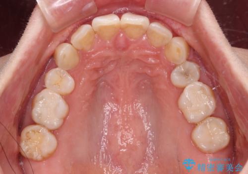 抜歯矯正の後戻りでできたスペース インビザライン矯正とセラミック治療の治療後