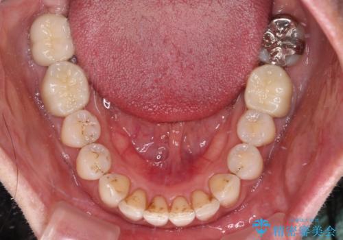 抜歯矯正の後戻りでできたスペース インビザライン矯正とセラミック治療の治療後