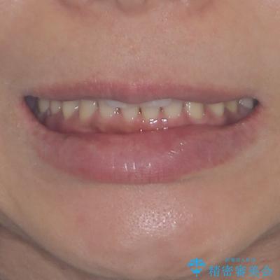 抜歯矯正の後戻りでできたスペース インビザライン矯正とセラミック治療の治療後(顔貌)