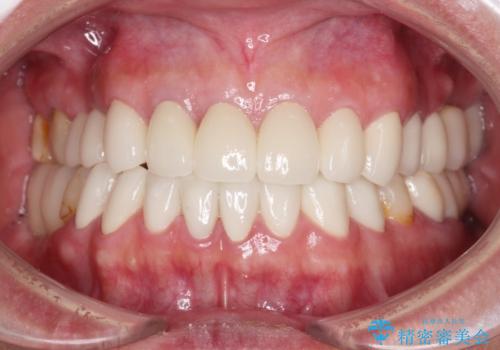 憧れの白い歯に　全顎セラミック治療の症例 治療後