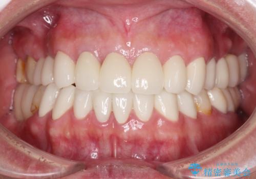 憧れの白い歯に 全顎セラミック治療