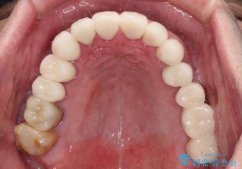 憧れの白い歯に　全顎セラミック治療の治療後