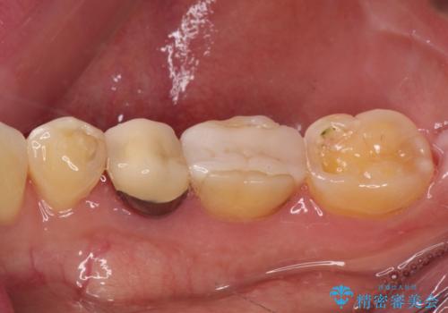 奥歯が欠けてしまった オールセラミッククラウンによる補綴治療の治療前