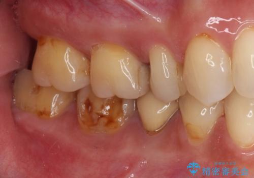 奥歯が欠けてしまった オールセラミッククラウンによる補綴治療の治療前