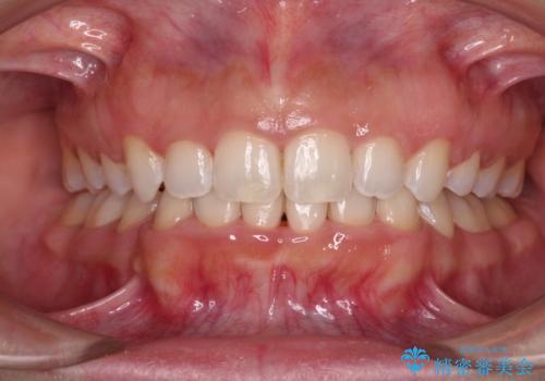 口がしっかりと閉じられない　ワイヤー装置での抜歯矯正で出っ歯を改善の治療後