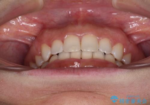 口がしっかりと閉じられない ワイヤー装置での抜歯矯正で出っ歯を改善の治療後