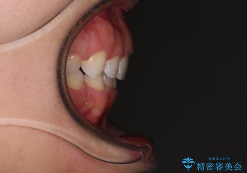 口がしっかりと閉じられない ワイヤー装置での抜歯矯正で出っ歯を改善の治療後