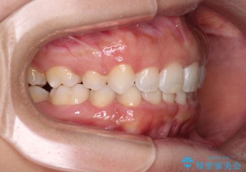 口がしっかりと閉じられない ワイヤー装置での抜歯矯正で出っ歯を改善の治療後
