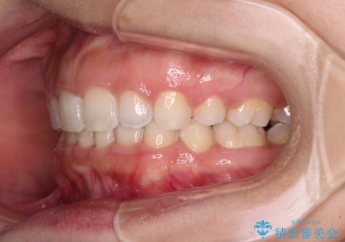 口がしっかりと閉じられない ワイヤー装置での抜歯矯正で出っ歯を改善の治療後