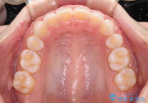 口がしっかりと閉じられない ワイヤー装置での抜歯矯正で出っ歯を改善の治療後