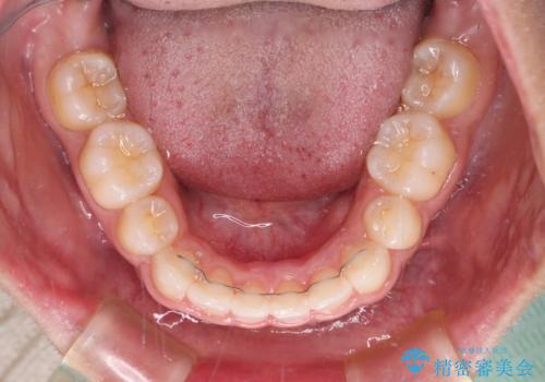 口がしっかりと閉じられない　ワイヤー装置での抜歯矯正で出っ歯を改善の治療後