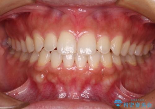 インビザラインを用いた上顎の部分矯正の症例 治療後