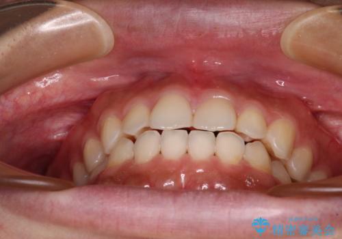 インビザラインを用いた上顎の部分矯正の治療後