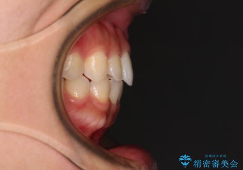 インビザラインを用いた上顎の部分矯正の治療後