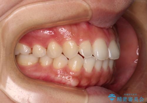 インビザラインを用いた上顎の部分矯正の治療後