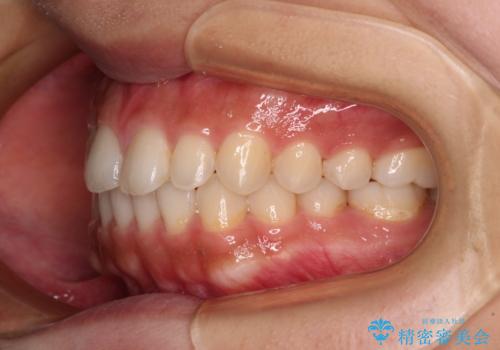 インビザラインを用いた上顎の部分矯正の治療後